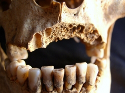 Towton sword cut in upper jaw